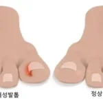 내성발톱